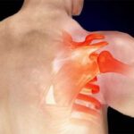 Omuz çıkığı belirtileri ve tedavisi nasıldır?